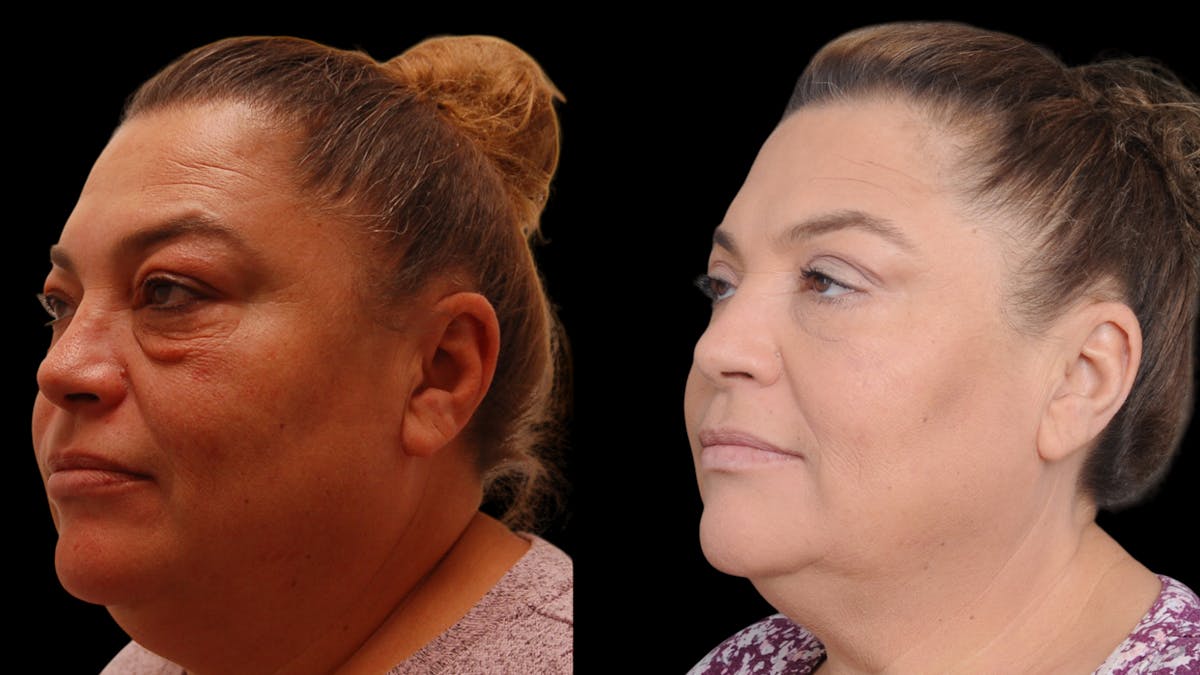 Upper & Lower Eyelid Surgery Before & After Gallery - Patient 156492 - Image 6