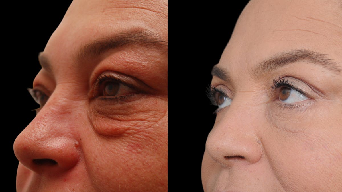 Upper & Lower Eyelid Surgery Before & After Gallery - Patient 156492 - Image 7