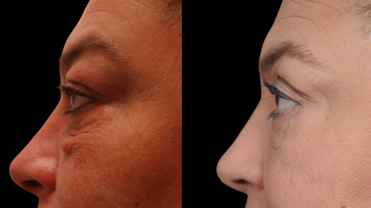 Upper & Lower Eyelid Surgery Before & After Gallery - Patient 156492 - Image 8