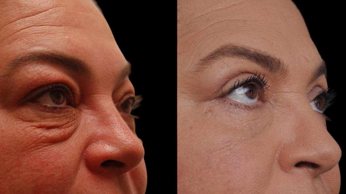 Upper & Lower Eyelid Surgery Before & After Gallery - Patient 156492 - Image 9