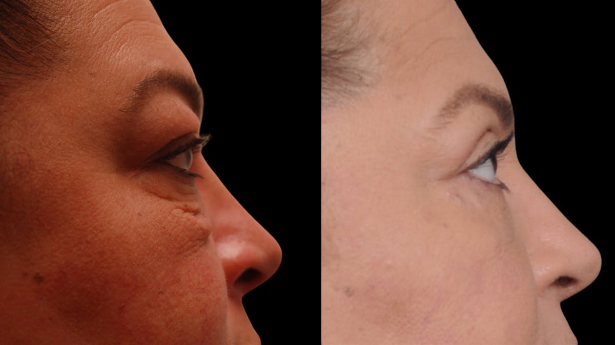 Upper & Lower Eyelid Surgery Before & After Gallery - Patient 156492 - Image 10