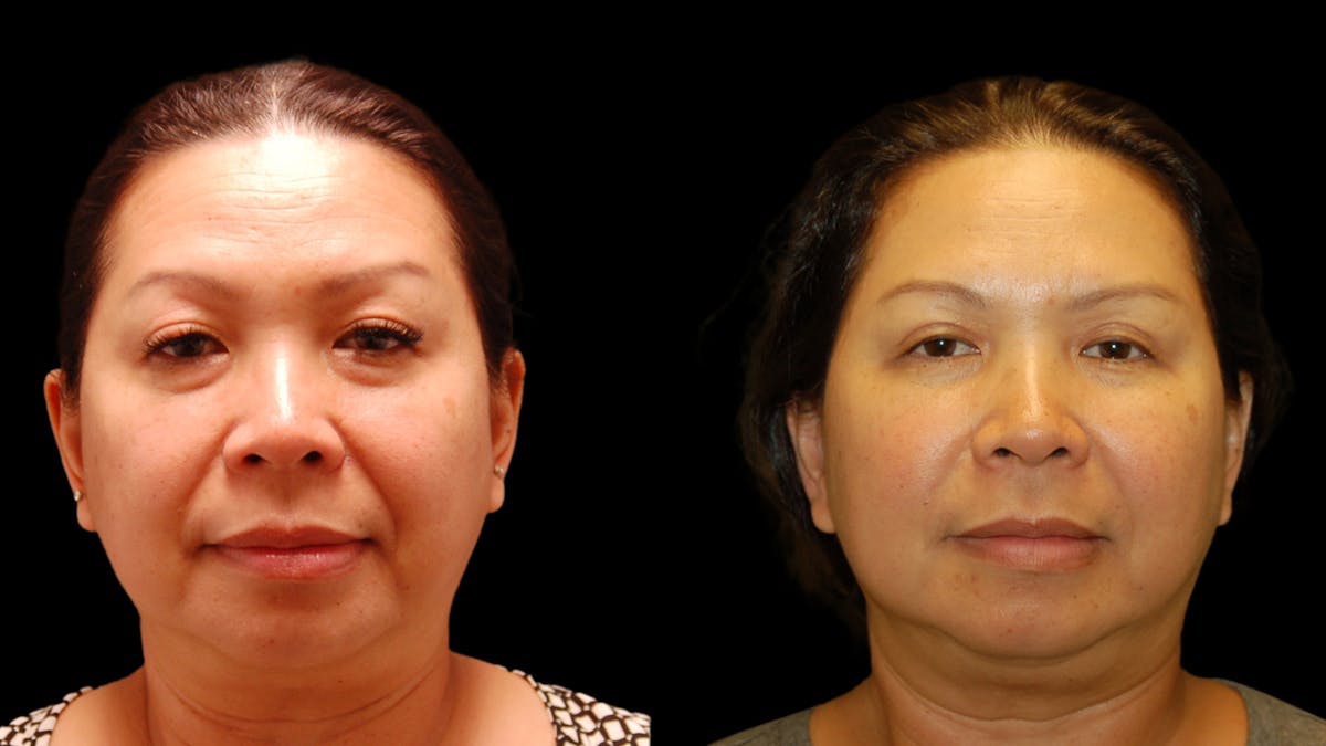Upper & Lower Eyelid Surgery Before & After Gallery - Patient 875602 - Image 1