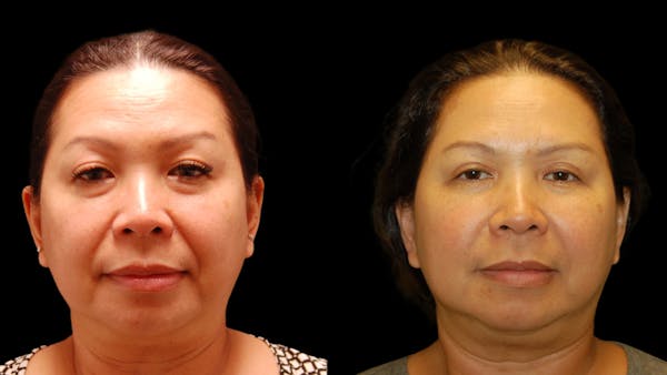 Upper & Lower Eyelid Surgery Before & After Gallery - Patient 875602 - Image 1