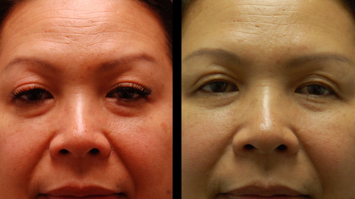 Upper & Lower Eyelid Surgery Before & After Gallery - Patient 875602 - Image 2