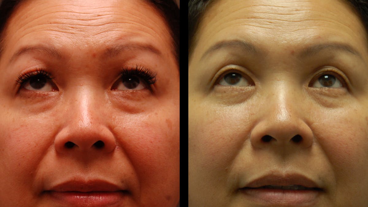 Upper & Lower Eyelid Surgery Before & After Gallery - Patient 875602 - Image 3