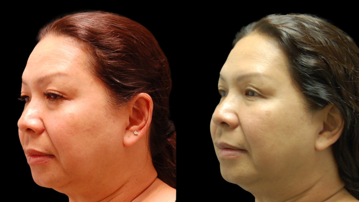 Upper & Lower Eyelid Surgery Before & After Gallery - Patient 875602 - Image 4