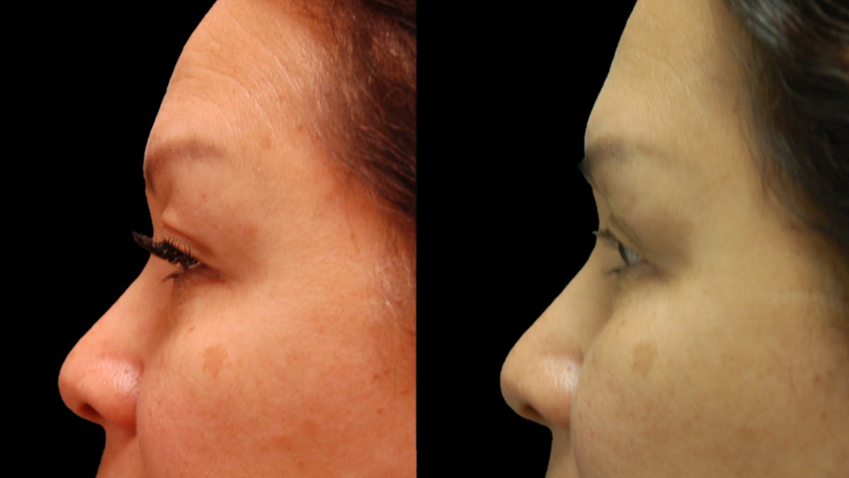 Upper & Lower Eyelid Surgery Before & After Gallery - Patient 875602 - Image 5