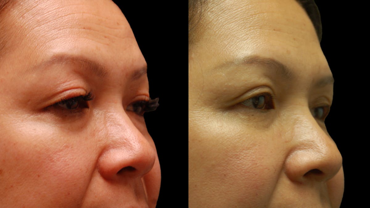 Upper & Lower Eyelid Surgery Before & After Gallery - Patient 875602 - Image 6