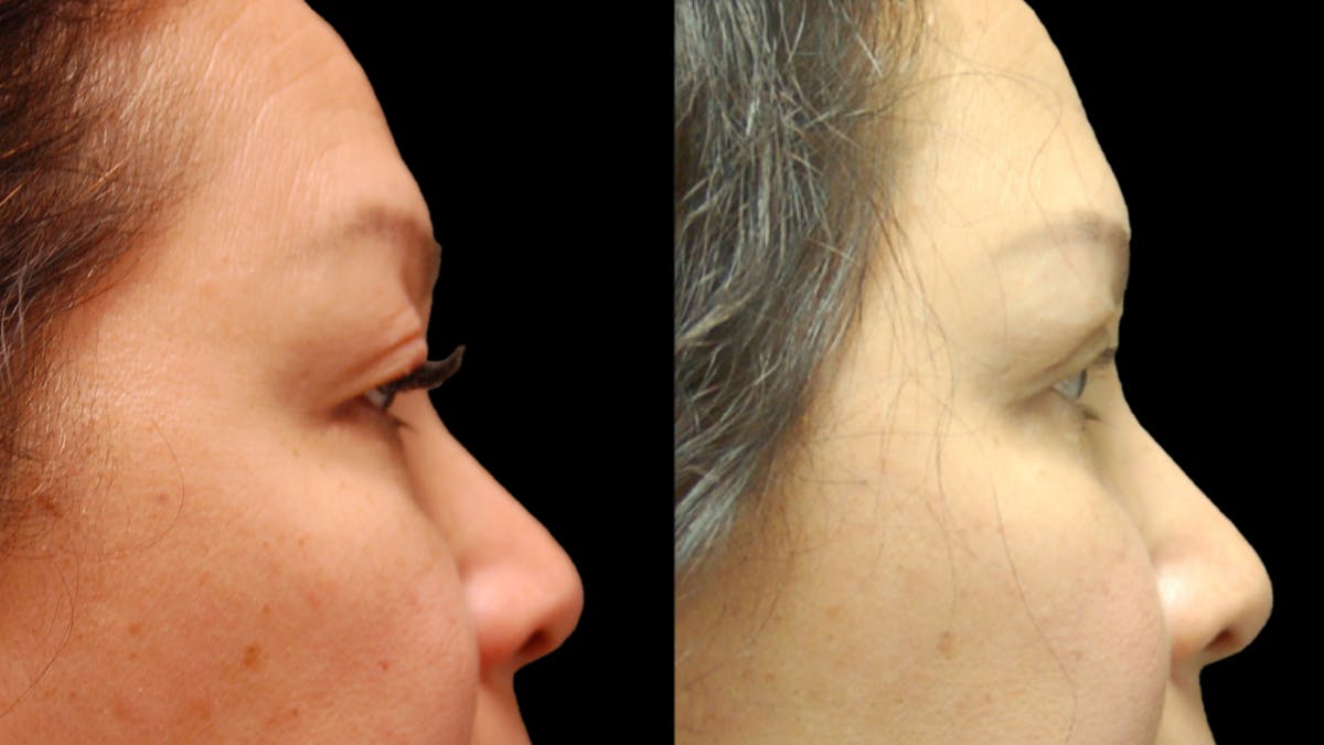 Upper & Lower Eyelid Surgery Before & After Gallery - Patient 875602 - Image 7