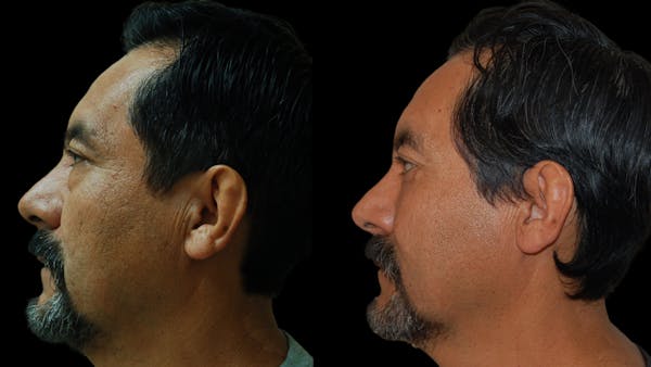 Upper & Lower Eyelid Surgery Before & After Gallery - Patient 496404 - Image 1