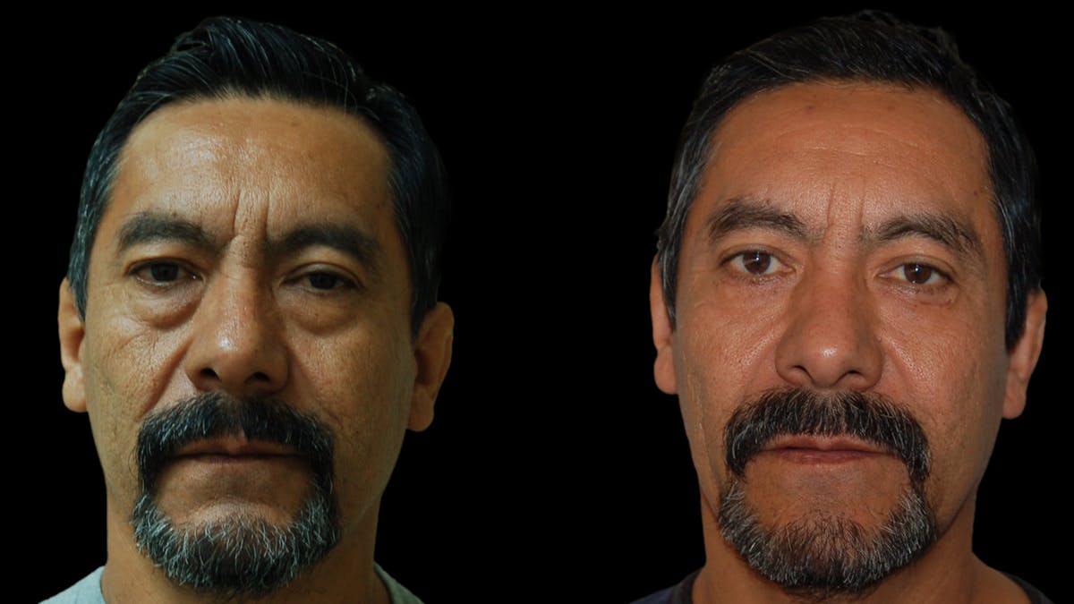 Upper & Lower Eyelid Surgery Before & After Gallery - Patient 496404 - Image 2