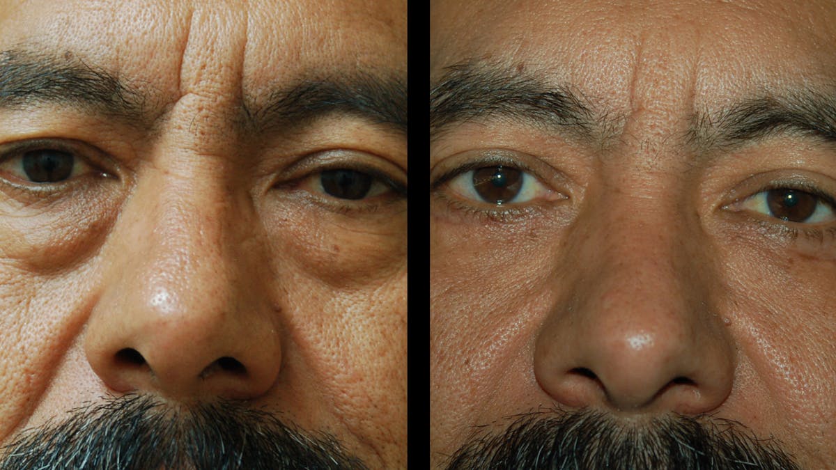 Upper & Lower Eyelid Surgery Before & After Gallery - Patient 496404 - Image 3