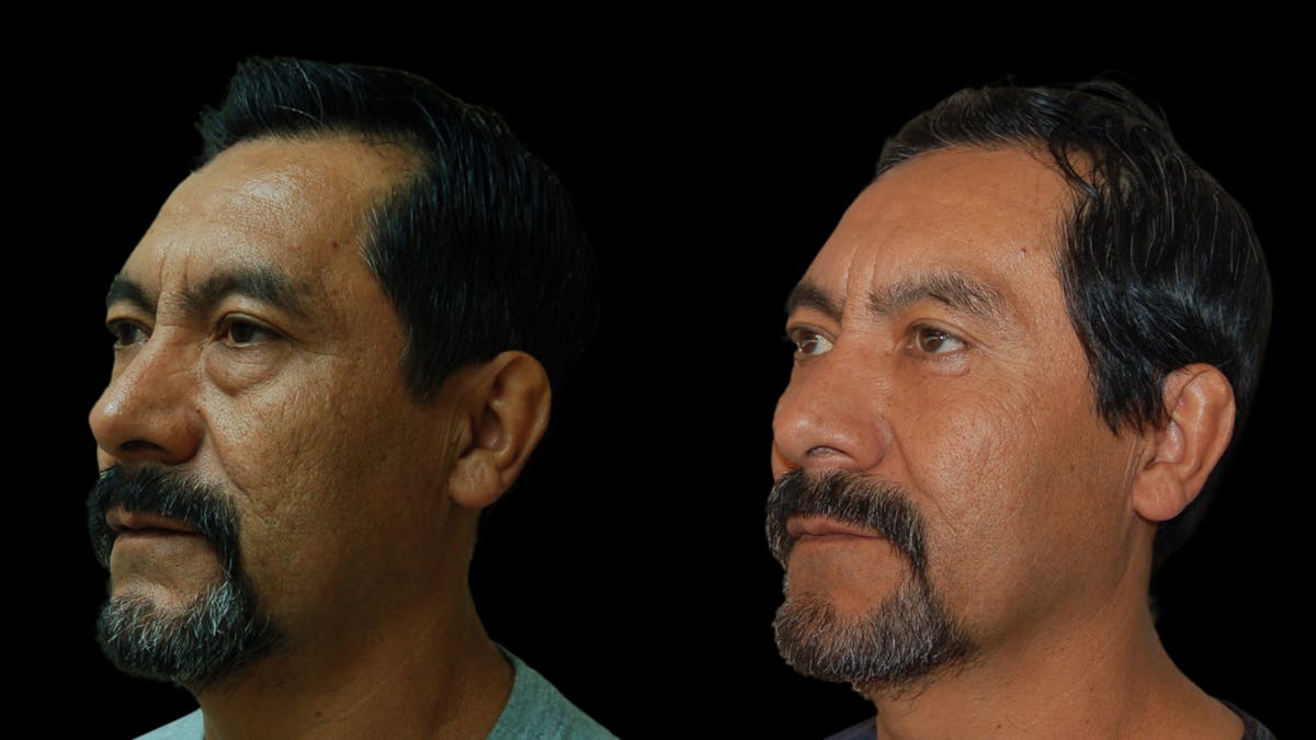 Upper & Lower Eyelid Surgery Before & After Gallery - Patient 496404 - Image 4