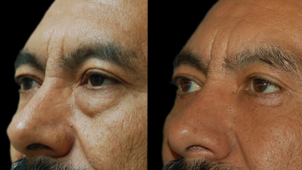 Upper & Lower Eyelid Surgery Before & After Gallery - Patient 496404 - Image 5