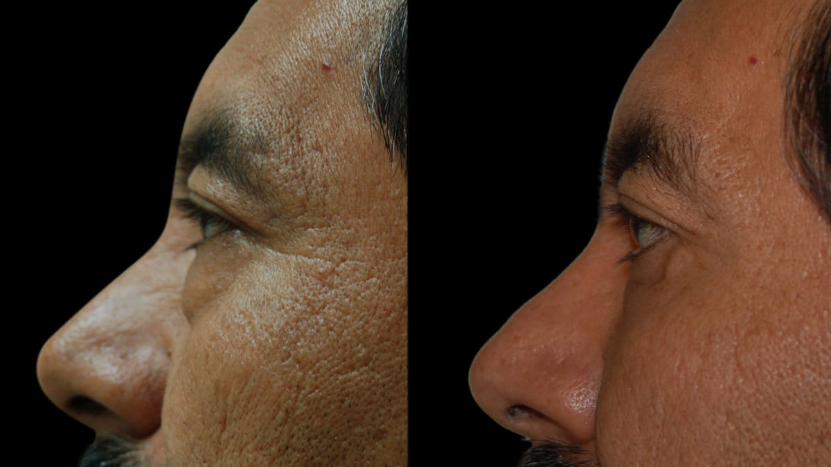 Upper & Lower Eyelid Surgery Before & After Gallery - Patient 496404 - Image 6