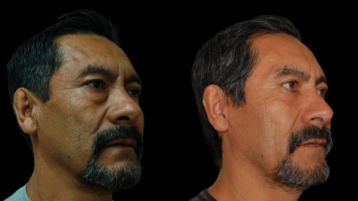 Upper & Lower Eyelid Surgery Before & After Gallery - Patient 496404 - Image 7