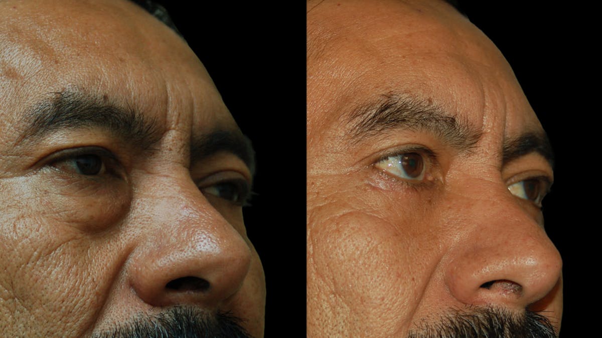 Upper & Lower Eyelid Surgery Before & After Gallery - Patient 496404 - Image 8