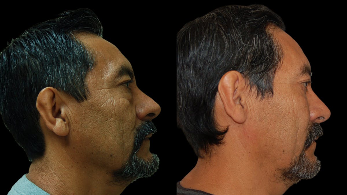 Upper & Lower Eyelid Surgery Before & After Gallery - Patient 496404 - Image 9