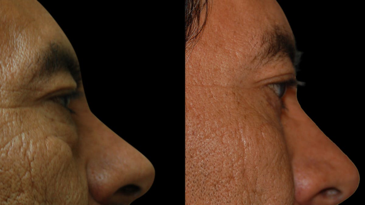 Upper & Lower Eyelid Surgery Before & After Gallery - Patient 496404 - Image 10