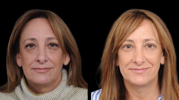Upper & Lower Eyelid Surgery Before & After Gallery - Patient 816934 - Image 1
