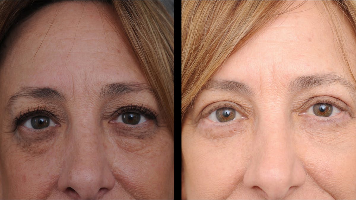 Upper & Lower Eyelid Surgery Before & After Gallery - Patient 816934 - Image 2