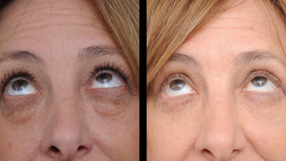 Upper & Lower Eyelid Surgery Before & After Gallery - Patient 816934 - Image 3
