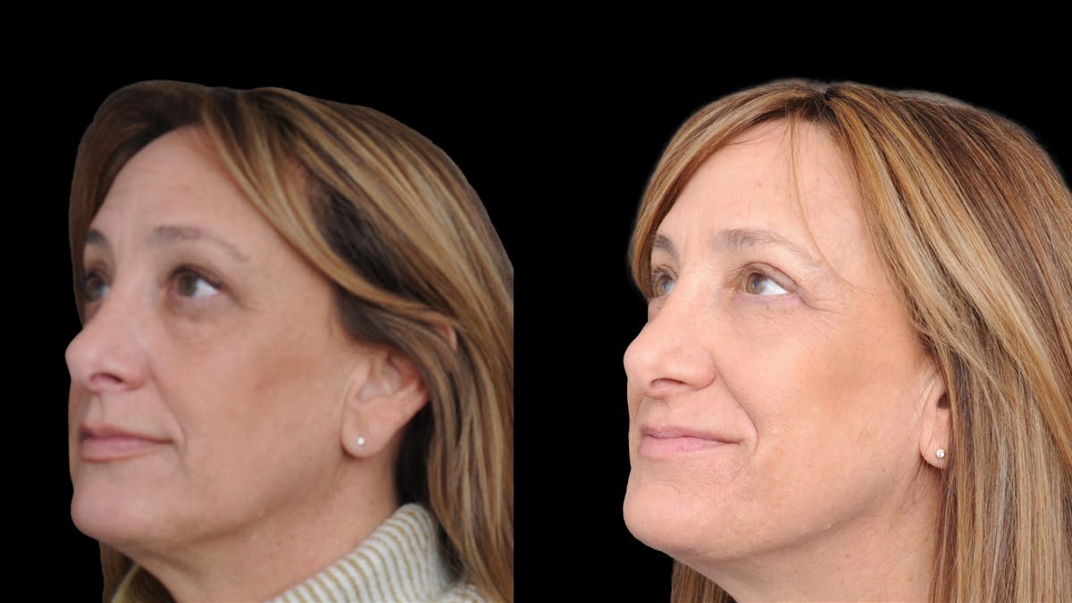 Upper & Lower Eyelid Surgery Before & After Gallery - Patient 816934 - Image 4