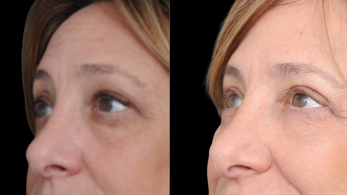 Upper & Lower Eyelid Surgery Before & After Gallery - Patient 816934 - Image 5