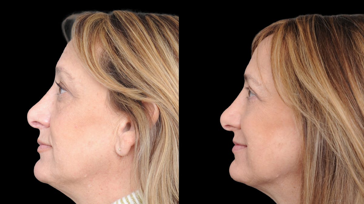 Upper & Lower Eyelid Surgery Before & After Gallery - Patient 816934 - Image 6