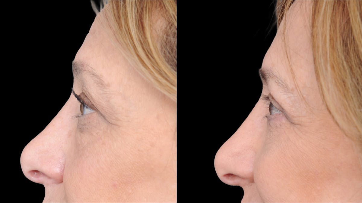 Upper & Lower Eyelid Surgery Before & After Gallery - Patient 816934 - Image 7