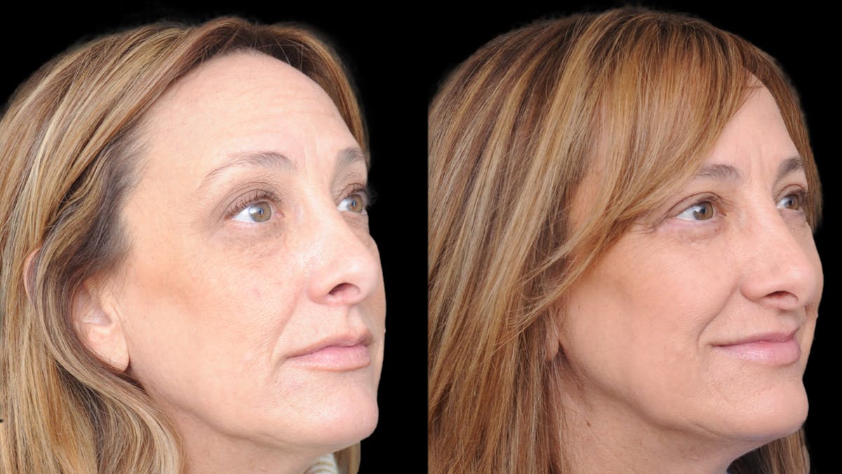 Upper & Lower Eyelid Surgery Before & After Gallery - Patient 816934 - Image 8