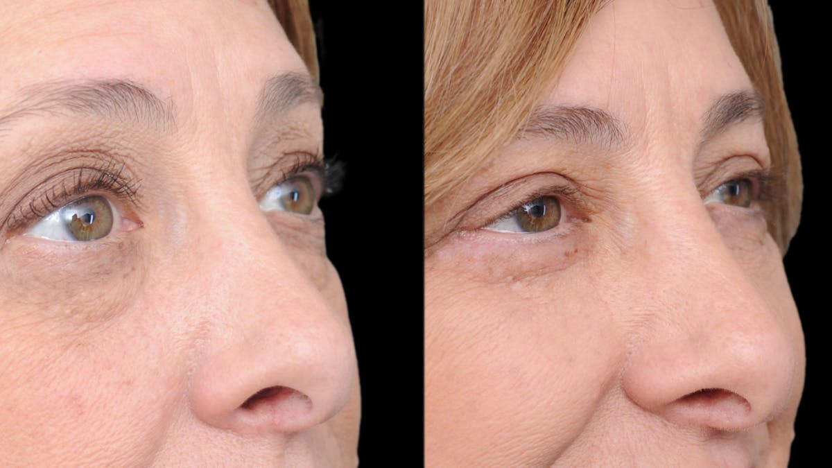 Upper & Lower Eyelid Surgery Before & After Gallery - Patient 816934 - Image 9