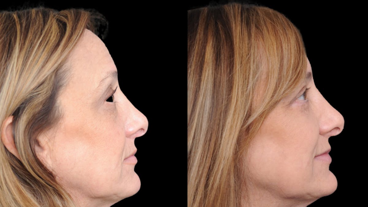 Upper & Lower Eyelid Surgery Before & After Gallery - Patient 816934 - Image 10