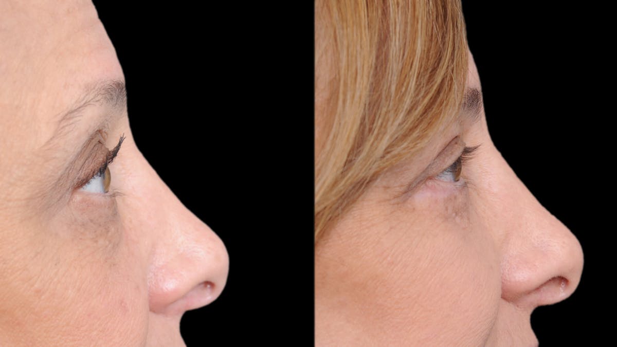 Upper & Lower Eyelid Surgery Before & After Gallery - Patient 816934 - Image 11