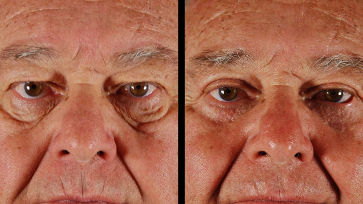 Upper & Lower Eyelid Surgery Before & After Gallery - Patient 121443 - Image 1