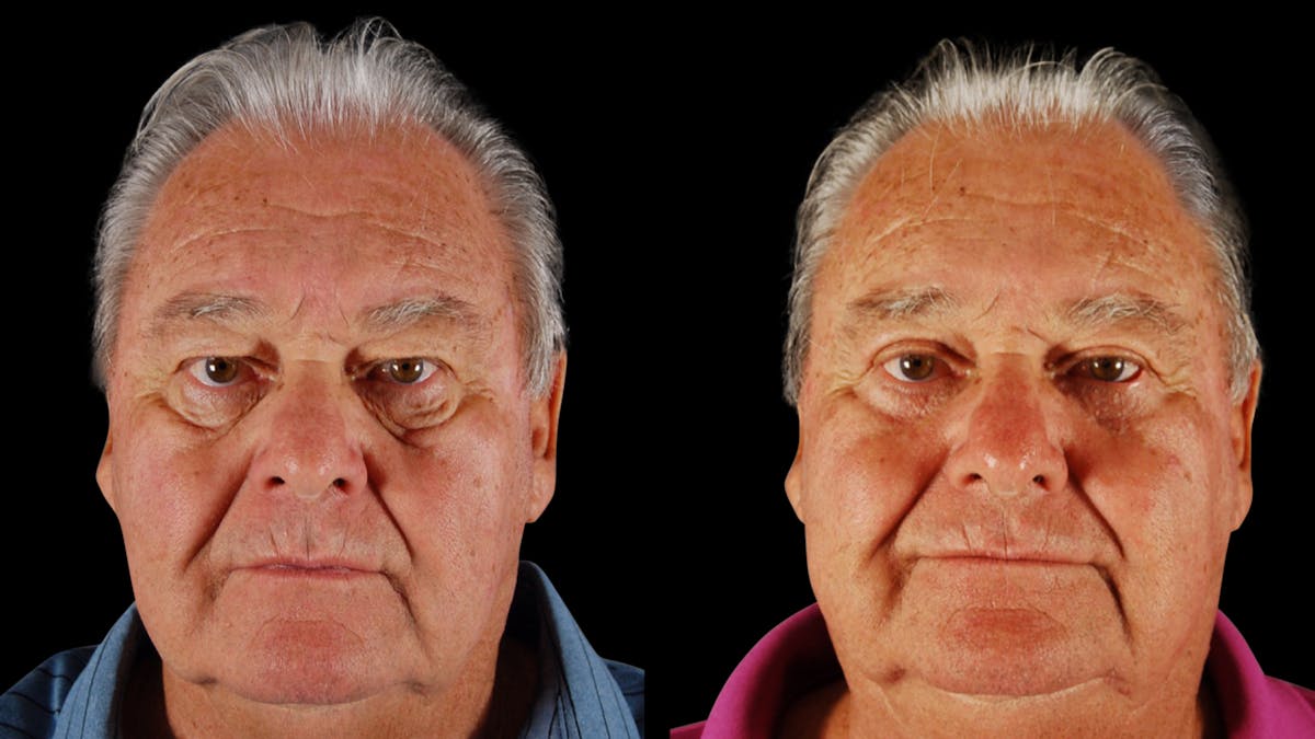 Upper & Lower Eyelid Surgery Before & After Gallery - Patient 121443 - Image 2