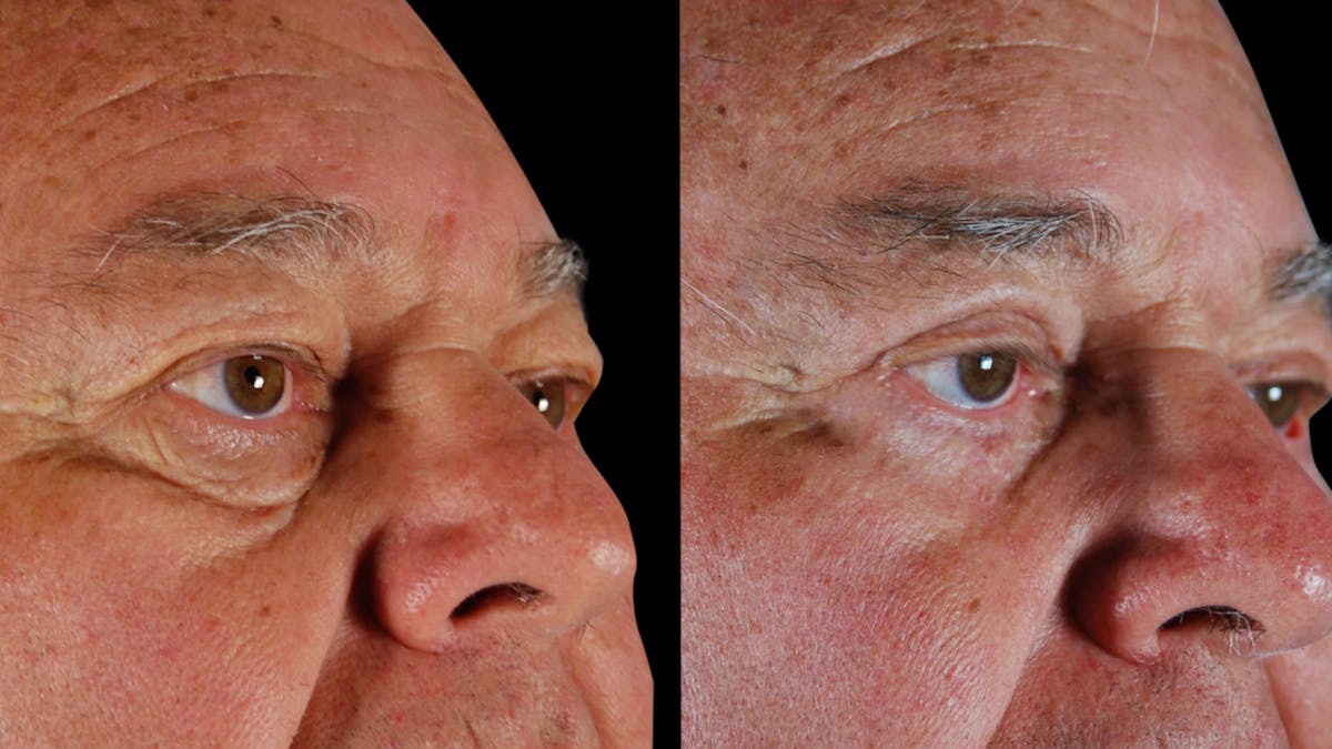 Upper & Lower Eyelid Surgery Before & After Gallery - Patient 121443 - Image 3