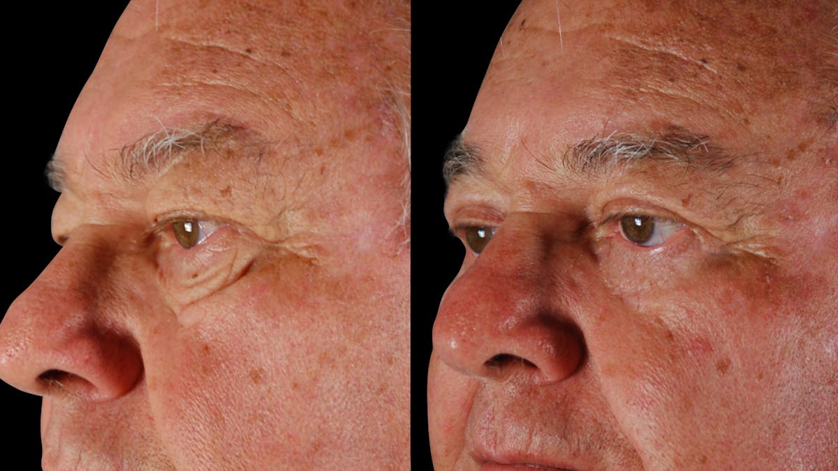 Upper & Lower Eyelid Surgery Before & After Gallery - Patient 121443 - Image 4