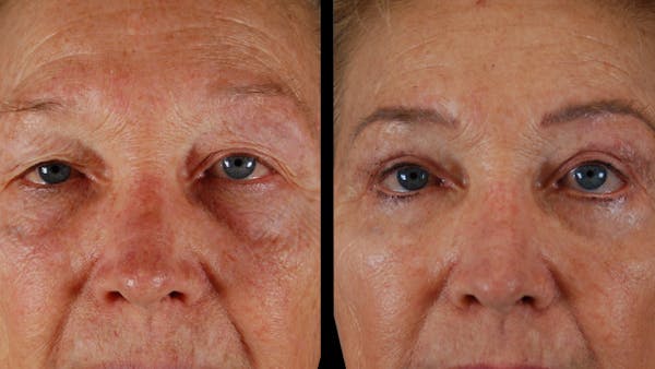 Upper & Lower Eyelid Surgery Before & After Gallery - Patient 612524 - Image 1