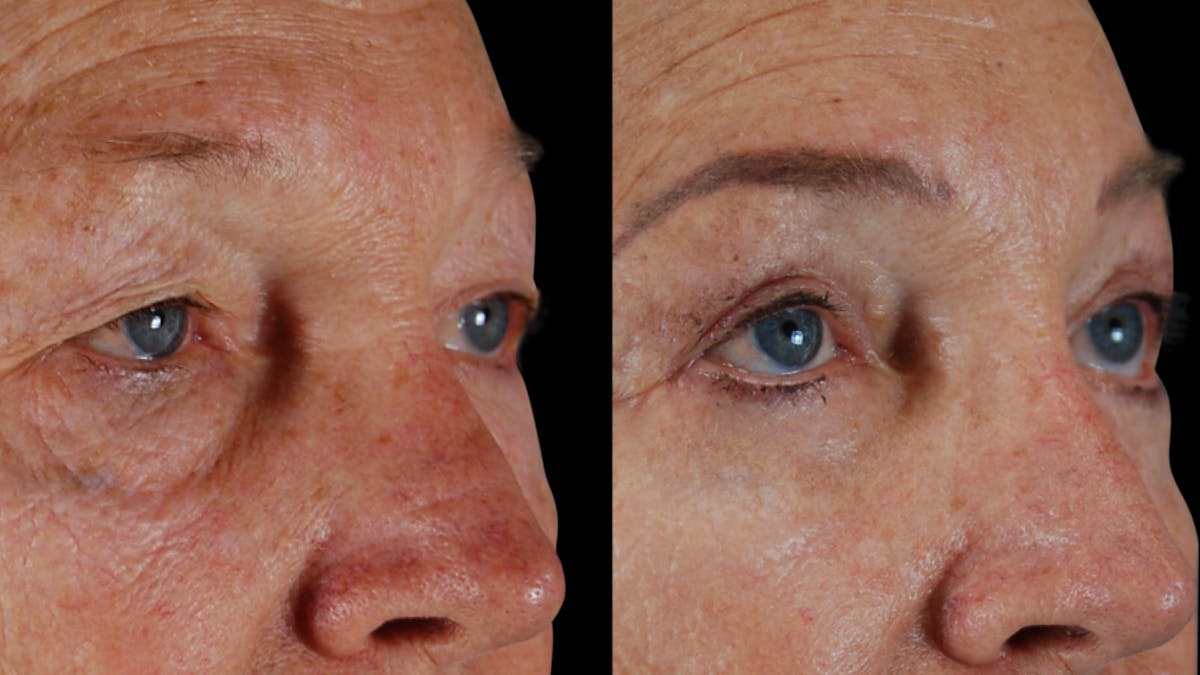 Upper & Lower Eyelid Surgery Before & After Gallery - Patient 612524 - Image 2