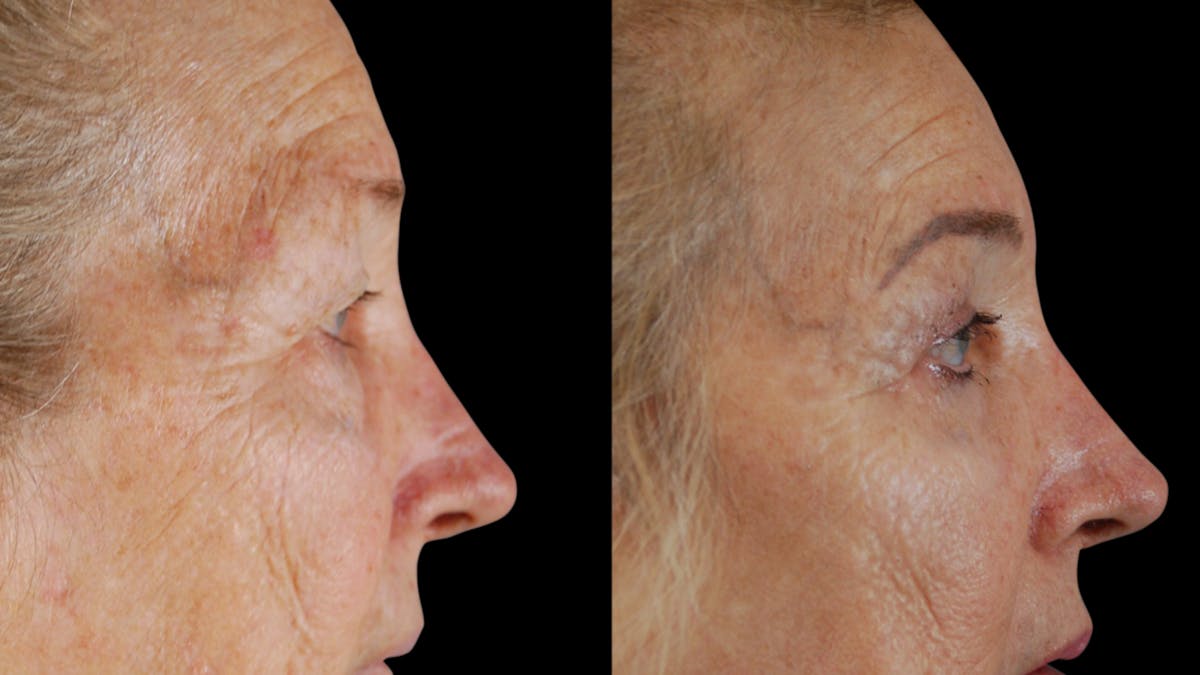 Upper & Lower Eyelid Surgery Before & After Gallery - Patient 612524 - Image 3