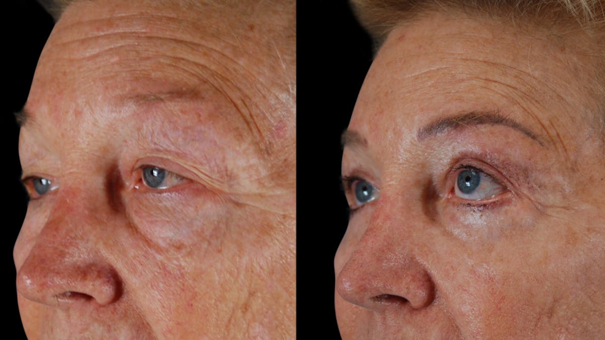 Upper & Lower Eyelid Surgery Before & After Gallery - Patient 612524 - Image 4