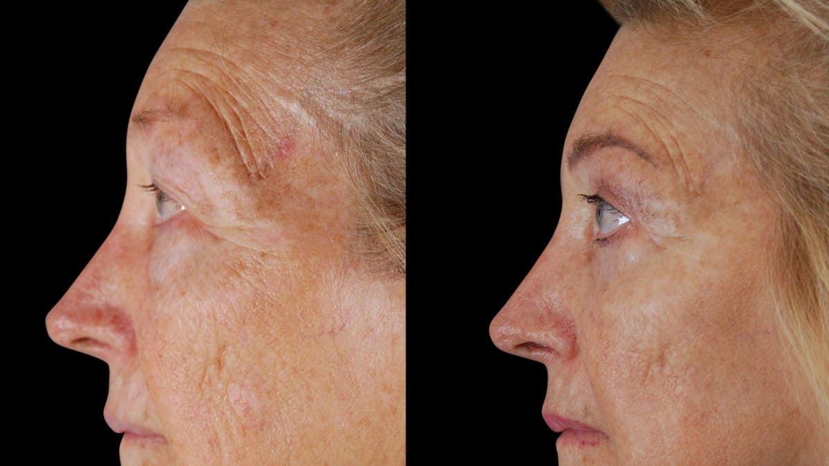Upper & Lower Eyelid Surgery Before & After Gallery - Patient 612524 - Image 5