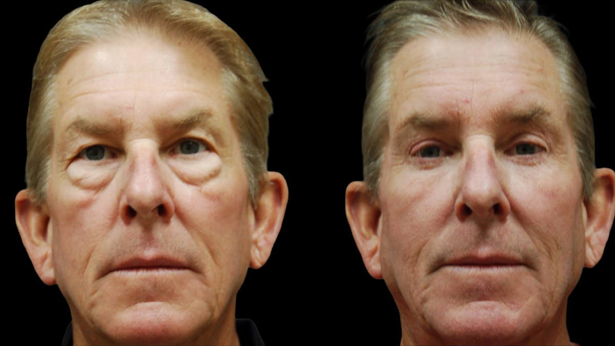 Upper & Lower Eyelid Surgery Before & After Gallery - Patient 181231 - Image 1