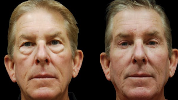 Upper & Lower Eyelid Surgery Before & After Gallery - Patient 181231 - Image 1