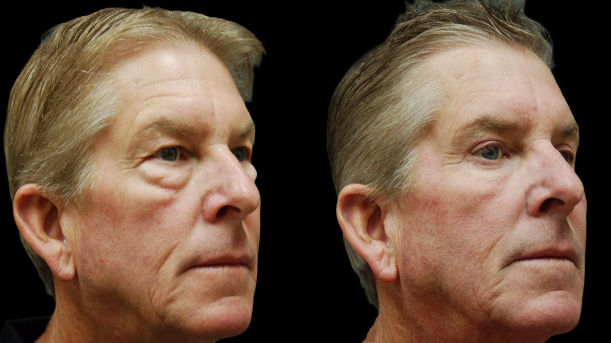 Upper & Lower Eyelid Surgery Before & After Gallery - Patient 181231 - Image 2