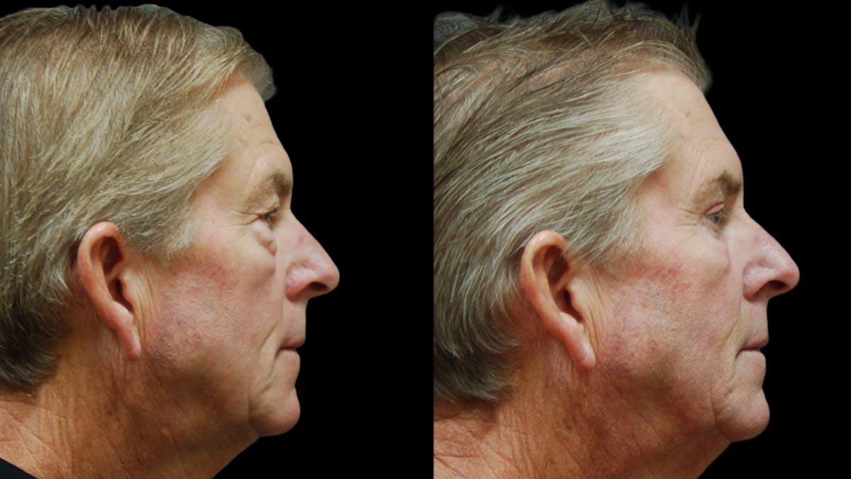 Upper & Lower Eyelid Surgery Before & After Gallery - Patient 181231 - Image 3