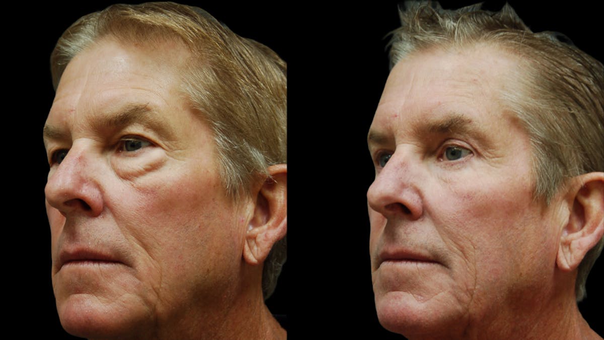 Upper & Lower Eyelid Surgery Before & After Gallery - Patient 181231 - Image 4
