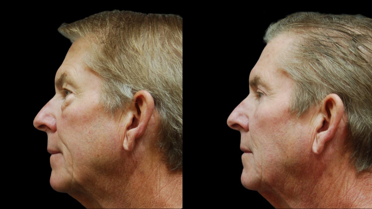 Upper & Lower Eyelid Surgery Before & After Gallery - Patient 181231 - Image 5