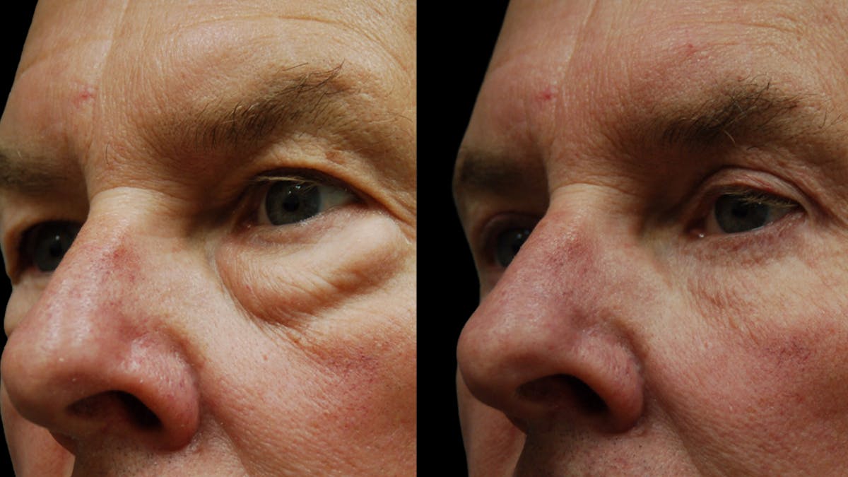 Upper & Lower Eyelid Surgery Before & After Gallery - Patient 181231 - Image 8
